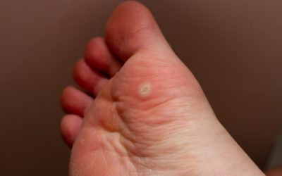 Breaking Down the Treatment Options for Warts