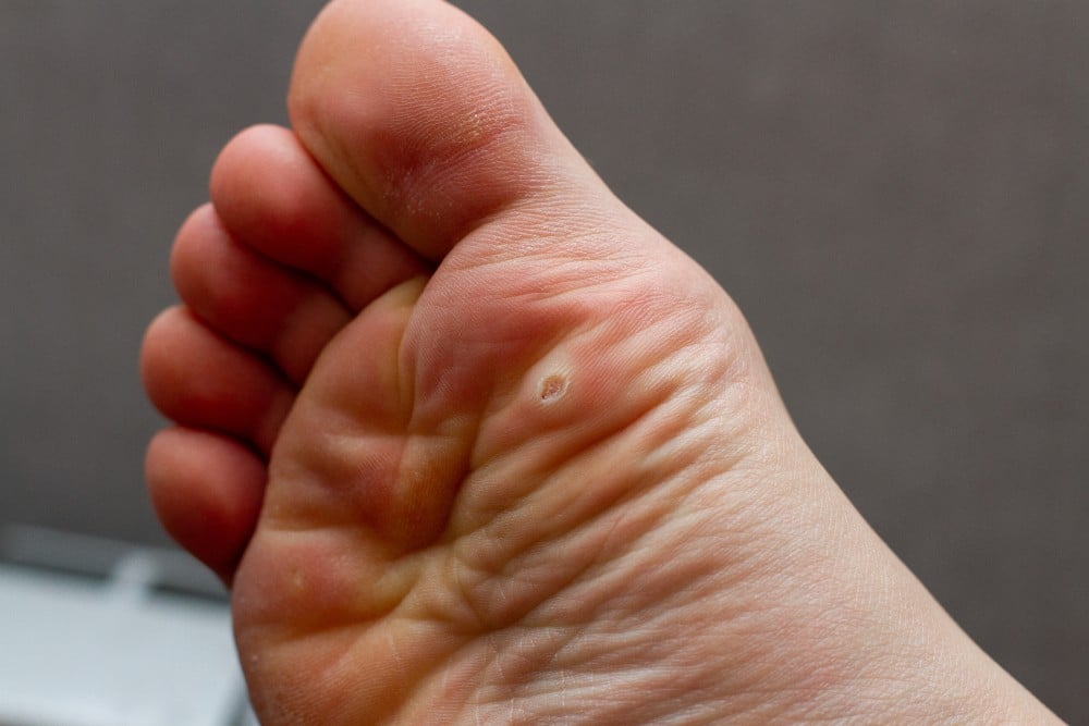 Plantar warts on bottom of foot