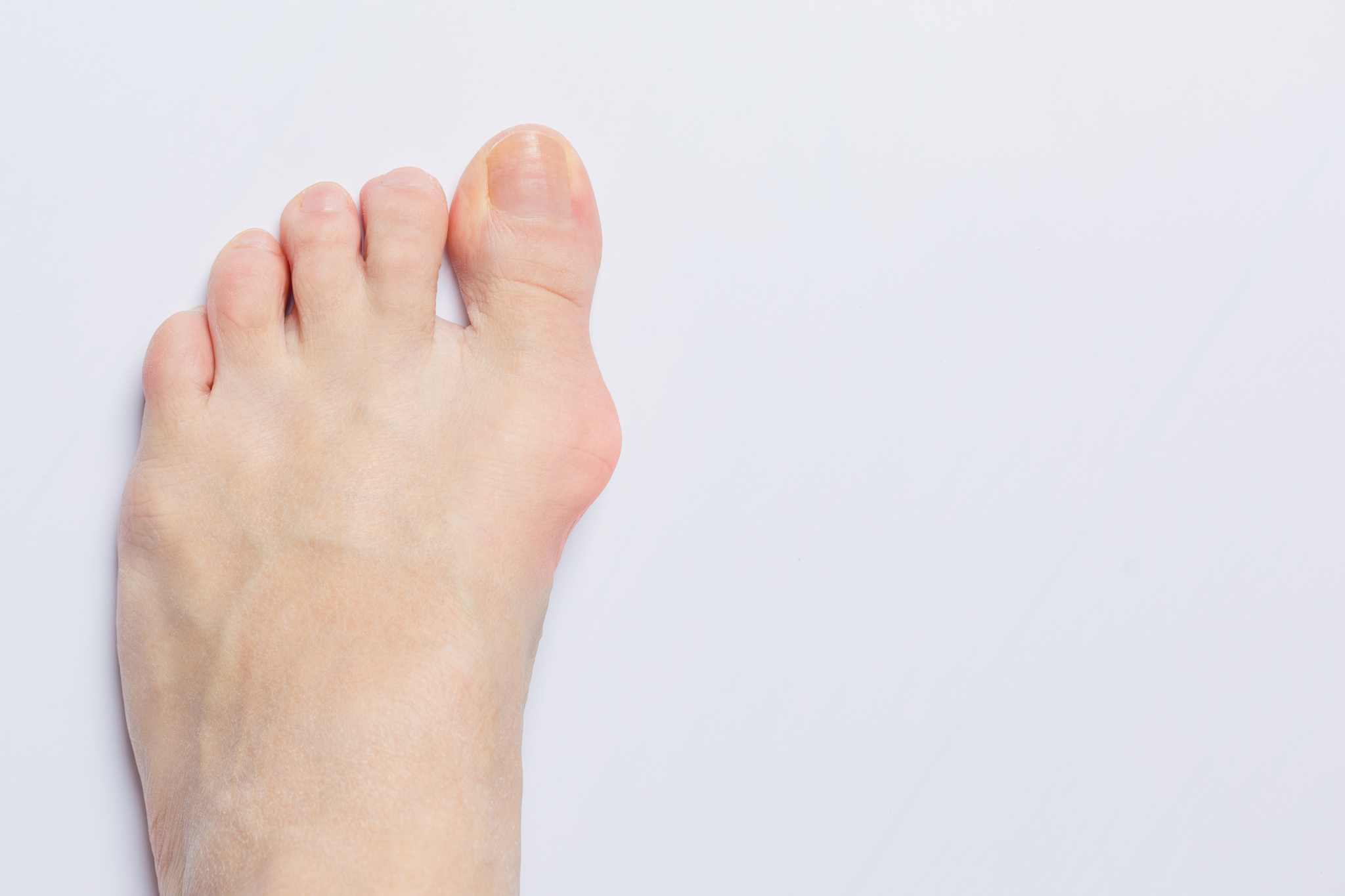 Foot with bunion on white background
