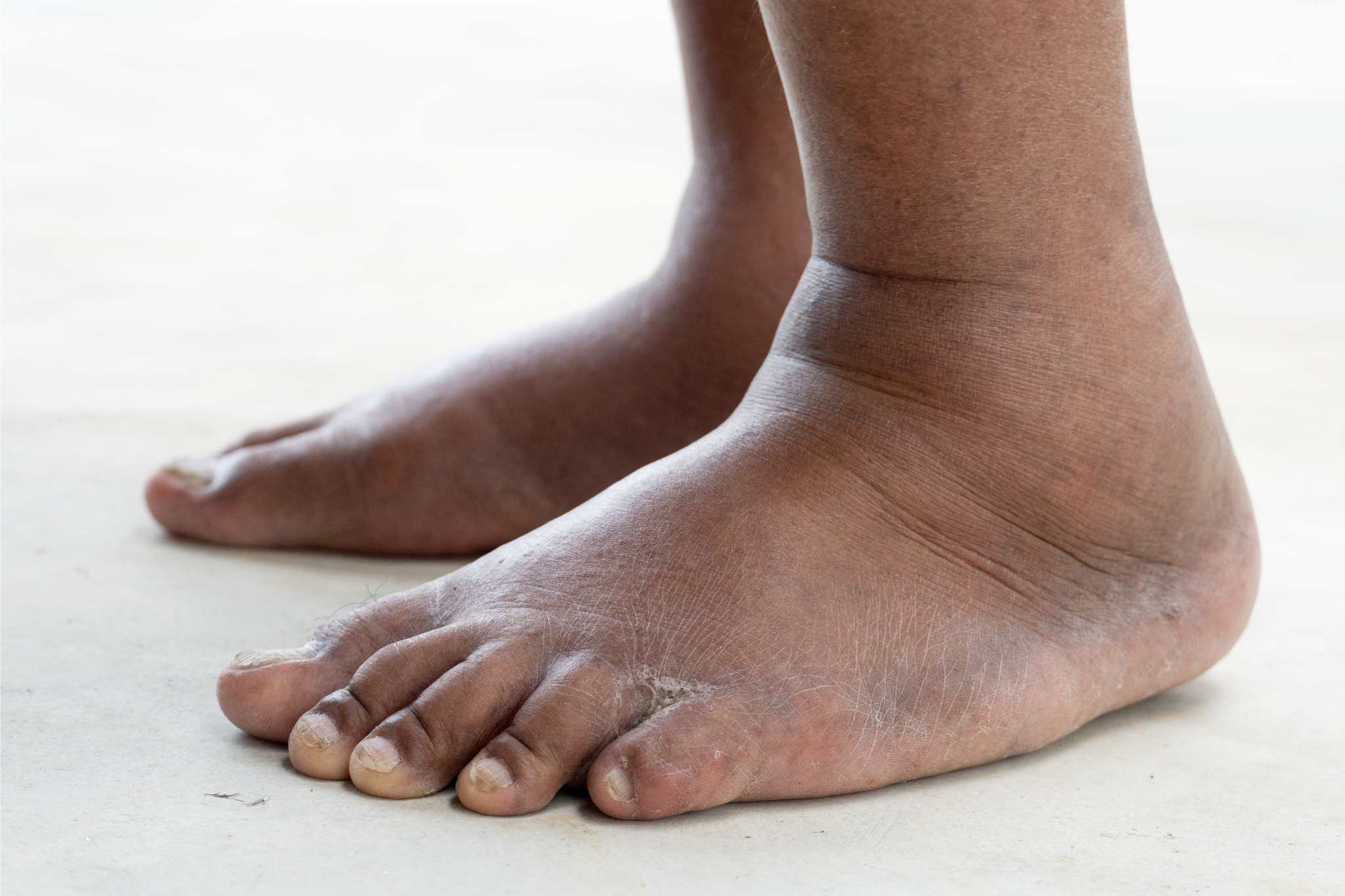 Side view of swollen feet on both sides. health problems of the elderly. Diabetes in the elderly and overweight. stand barefoot on the concrete floor.
